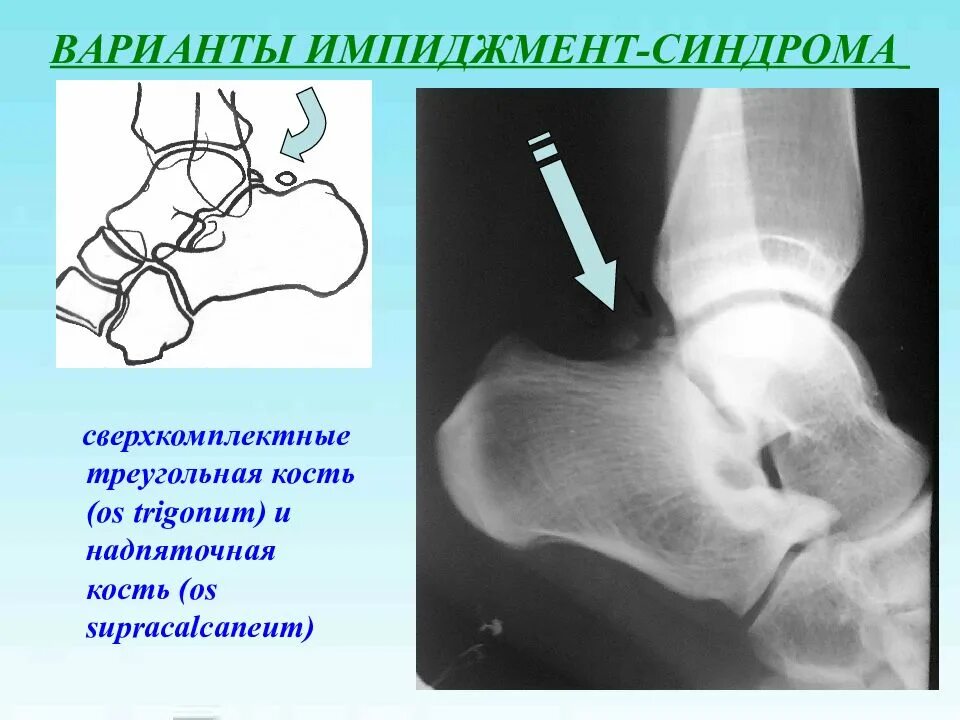 Синдромы голеностопного сустава. Импиджмент синдром голеностопного сустава. Импиджмент синдром голеностопного сустава рентген. Остеофит таранной кости. Таранная кость импиджмент.