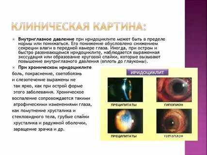 Диагностика иридоциклита