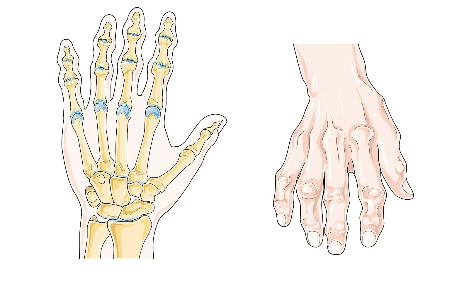 Суставы пальцев сильно. Ревматоидный артрит суставы. Деформирующий остеоартроз суставов кисти. Ревматоидный артрит сустава рисунок. Ревматоидный артрит кисти.