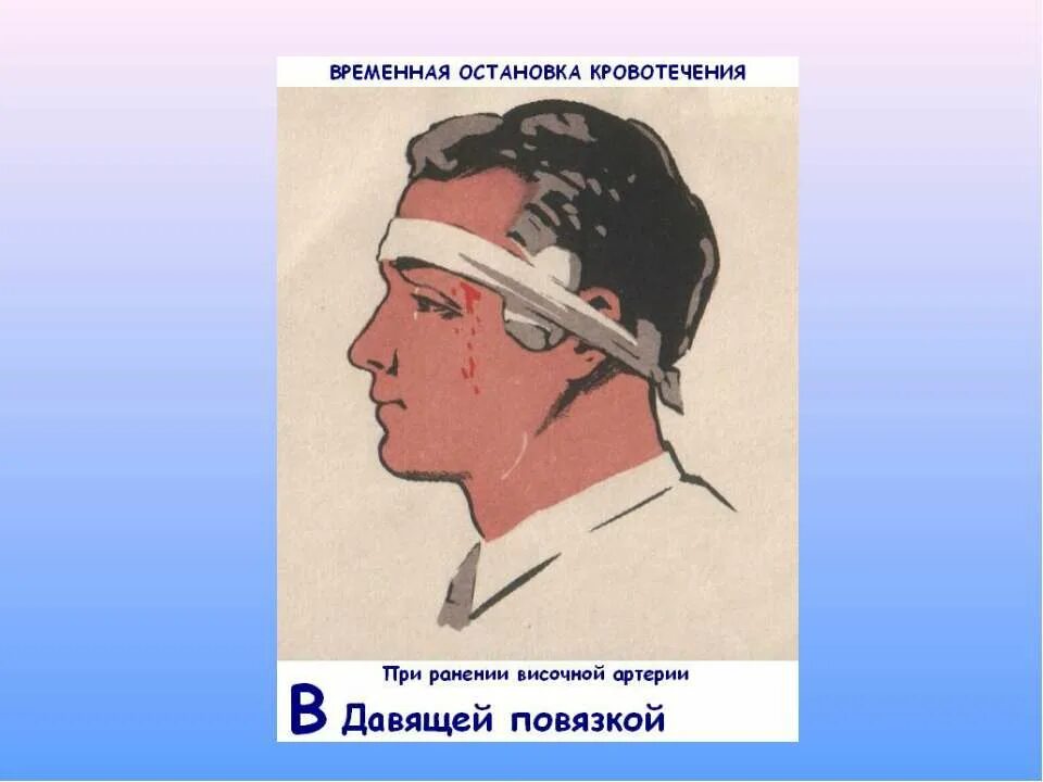 Остановка кровотечения на голове. Остановка кровотечения из РАН головы. Давящая повязка на сонную артерию. Давящая повязка на голову при кровотечении.