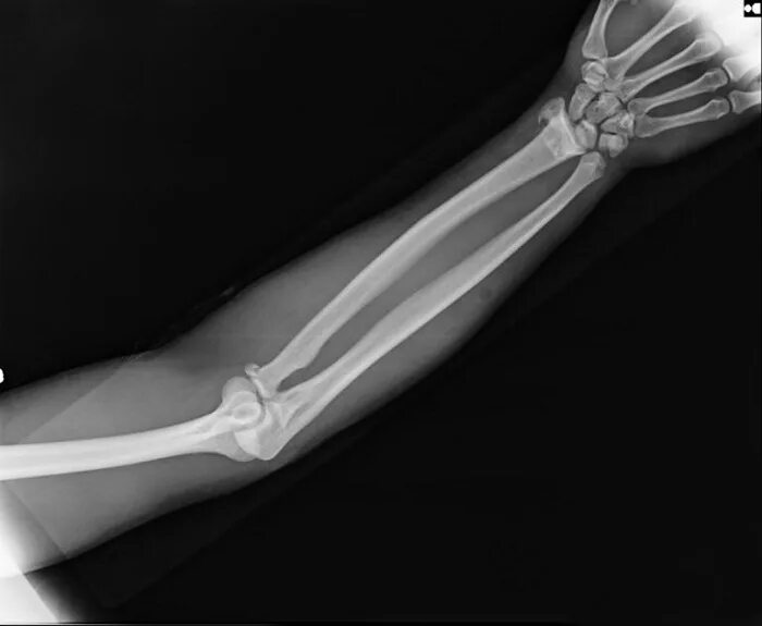 Перелом лучевой кости рентген. Кости предплечья рентген норма. Рентген лучезапястный сустав перелом лучевой кости. Перелом локтевого рентген.