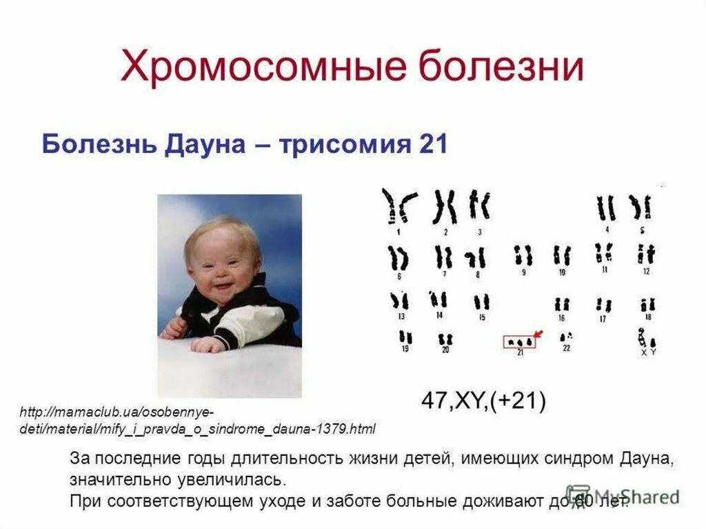 Появление дополнительной хромосомы. Синдром Дауна 21 хромосома. Синдром Дауна трисомия 21 хромосомы. Синдром Дауна (трисомия по 21-Ой хромосоме);. Болезнь Дауна трисомия 21.