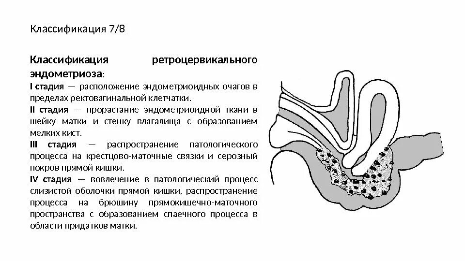 Эндометриоз классификация стадии ретроцервикальный. Классификация эндометриоза ретроцервикальной локализации. Ретроцервикальный эндометриоз степени. Ретроцервикальный эндометриоз 1 стадия.