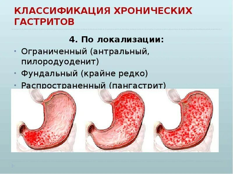 Хронический фундальный гастрит. Хронический антральный гастрит этиология. Фундальный атрофический гастрит. Классификация гастрита по локализации.