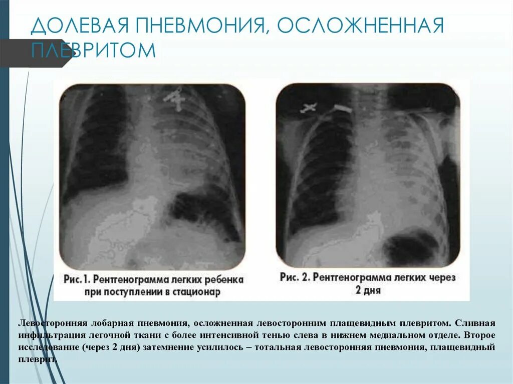 Легкие после поражения. Двусторонняя пневмония и плеврит.