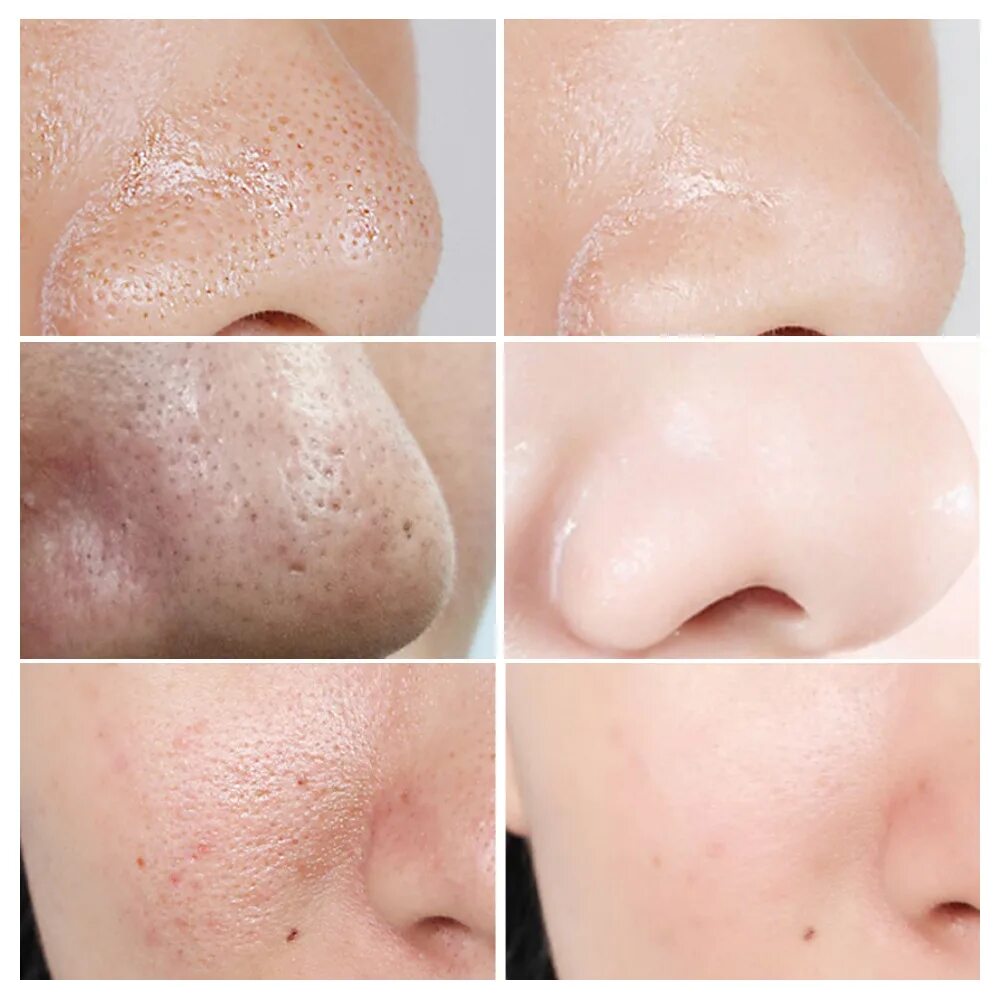 Удаление прыщей чистка. Удаление прыщей чистка. Meizer экстрактор двойной (инструмент для чистки лица и пор) а-4 /10/. Blackhead remover вакуумный очиститель. Механическая чистка лица у косметолога.