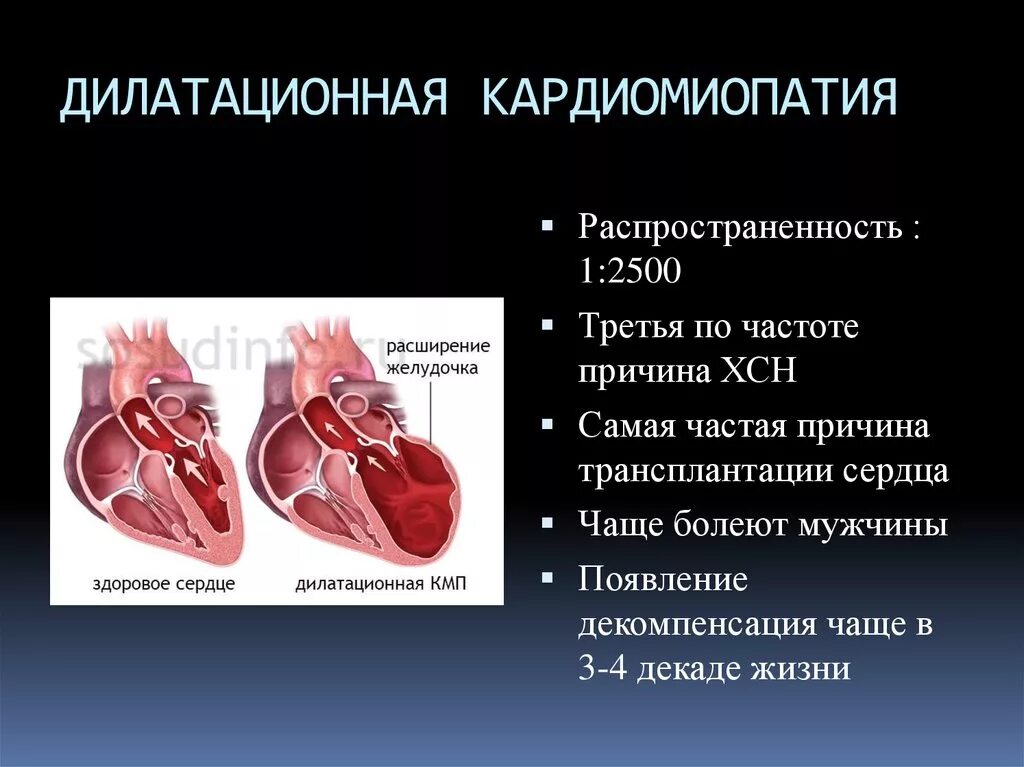 Заболевания левого желудочка. Причины дилатационная кардиопатия. Клинические симптомы кардиомиопатии. Форма сердца при дилатационной кардиомиопатии. Осложнения дилатационной кардиомиопатии.