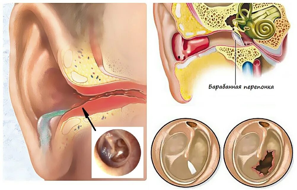Острый Гнойный средний отит барабанная перепонка. Гнойный отит барабанная перепонка. Барабанной перепонкой и внутренним ухом