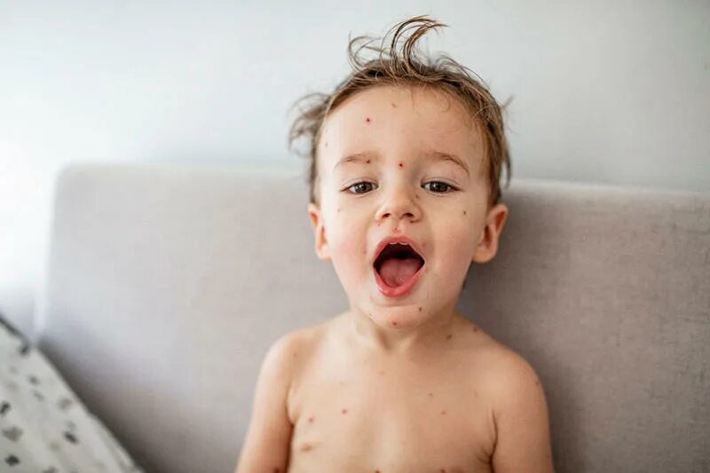 Ветряная оспа у детей фото в горле From asthma to meningitis the bumper family health guide which could be differ