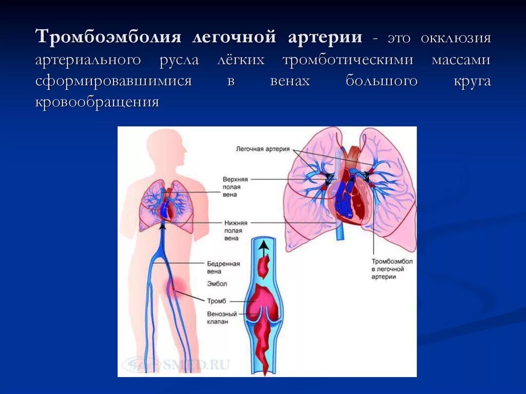 Легочная артерия. Тромбоэмболия легочной артерии. Легочные сосуды. Человек с тромбоэмболией легочной артерии. Сколько легочных артерий