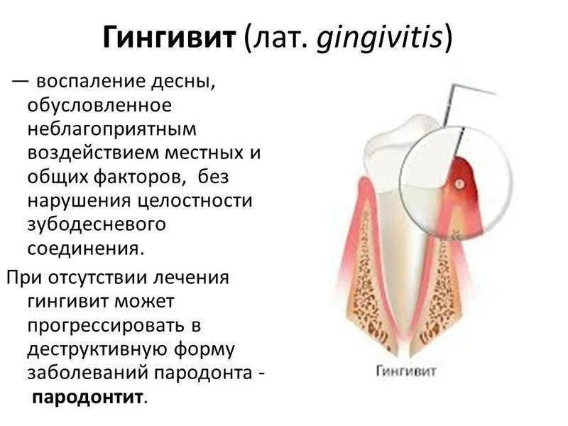 Заболевания пародонта гингивит. Воспалительные заболевания пародонта гингивит пародонтит. Гинвит.