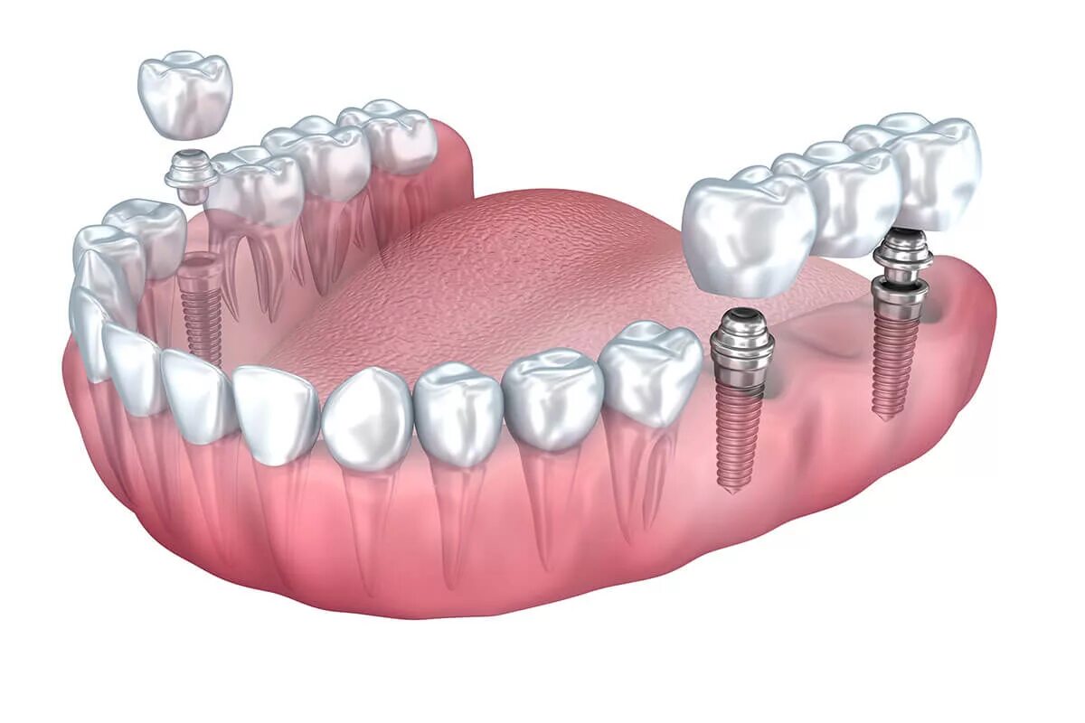 Имплантаты Dentium Superline. Мостовидный протез на 6 имплантах. Классическая двухэтапная имплантация. Мостовидный протез на 4 зуба.