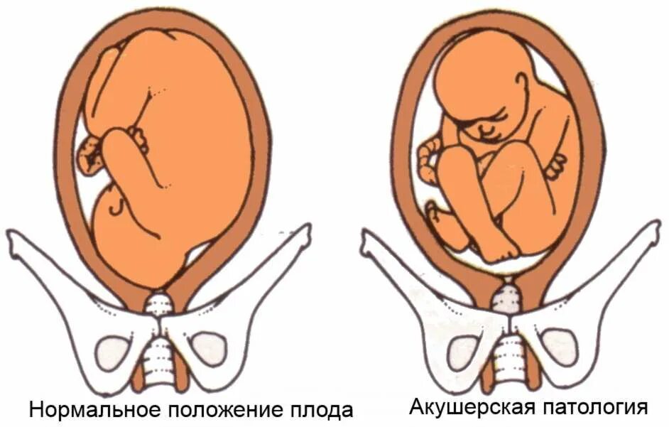 Ребенок расположен справа. Тазовое продольное предлежание. Тазовое продольное предлежание плода. Расположение ребенка головкой вниз. Расположение ребенка в тазовом предлежании.