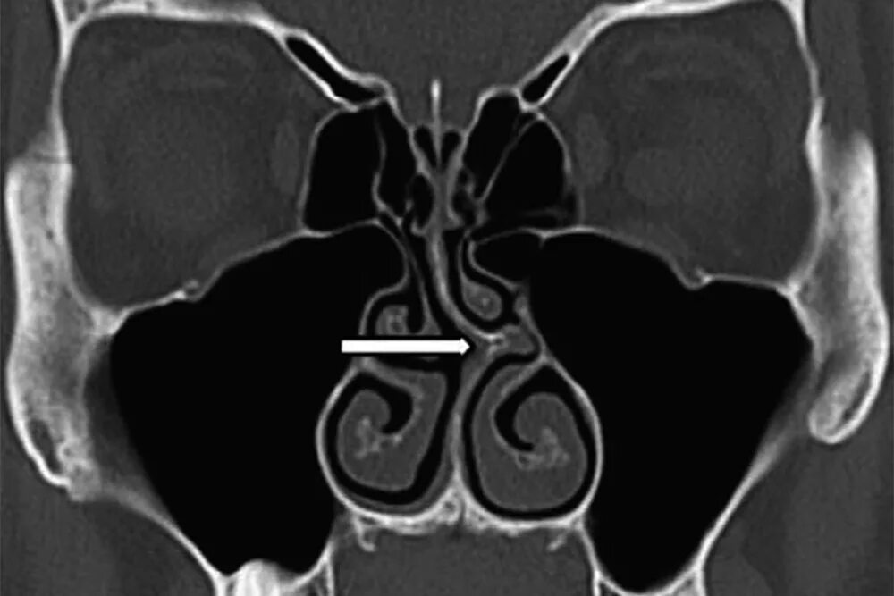 Удаление гребня. Перфорация носовой перегородки на кт. Кт искривленной носовой перегородки. Кривая носовая перегородка на кт. Перфорация перегородки носа на кт.
