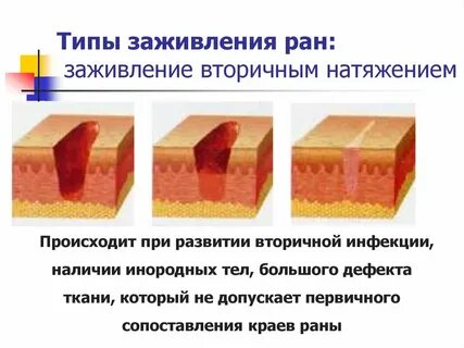 Вид рубца при заживлении раны первичным