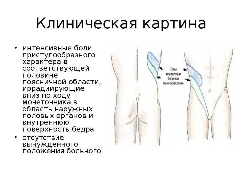 Иррадиация боли в паховую область