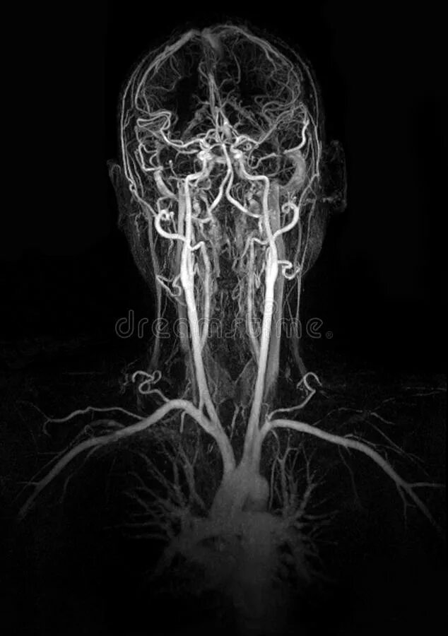Магнитно-резонансная ангиография шеи. Кт ангиография сосудов головного мозга. Кт ангиография сосудов шеи. МР-ангиография артерий шеи.