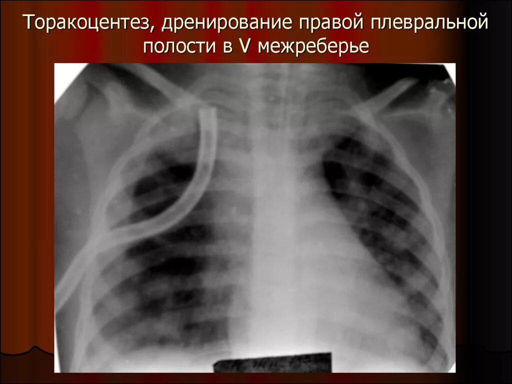 дренирование легкого. методика дренирования плевральной полости. дренирование плевральной полости при пневмотораксе. система дренирования по бюлау. дренирование плевральной полости двумя дренажами.