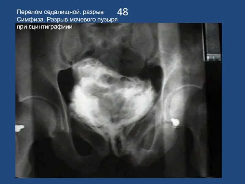 Внутрибрюшинный разрыв. Внутрибрюшинный разрыв мочевого пузыря рентген. Рентгенограмма при разрыве мочевого пузыря. Цистография разрыв мочевого пузыря. Ретроградная цистография мочевого пузыря травма.