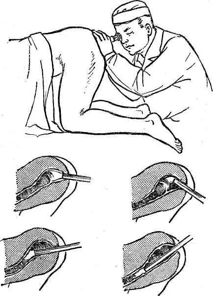Операции через прямую кишку. Пальцевое ректальное исследование при аппендиците. Ректороманоскопия (ректоскопия). Пальцевое исследование и ректоскопия. Осмотр прямой кишки пальцевое исследование.