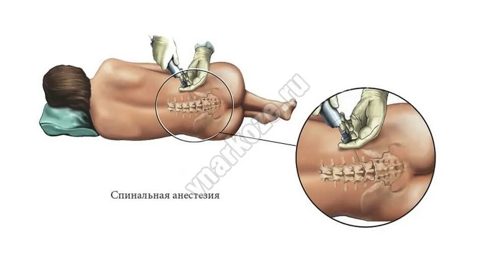 При кесаревом сечении делают наркоз. Спинальная анестезия при кесаревом сечении. Спинной наркоз при кесаревом. Помпа спинальная для обезболивания. Анестезия в позвоночник как называется.