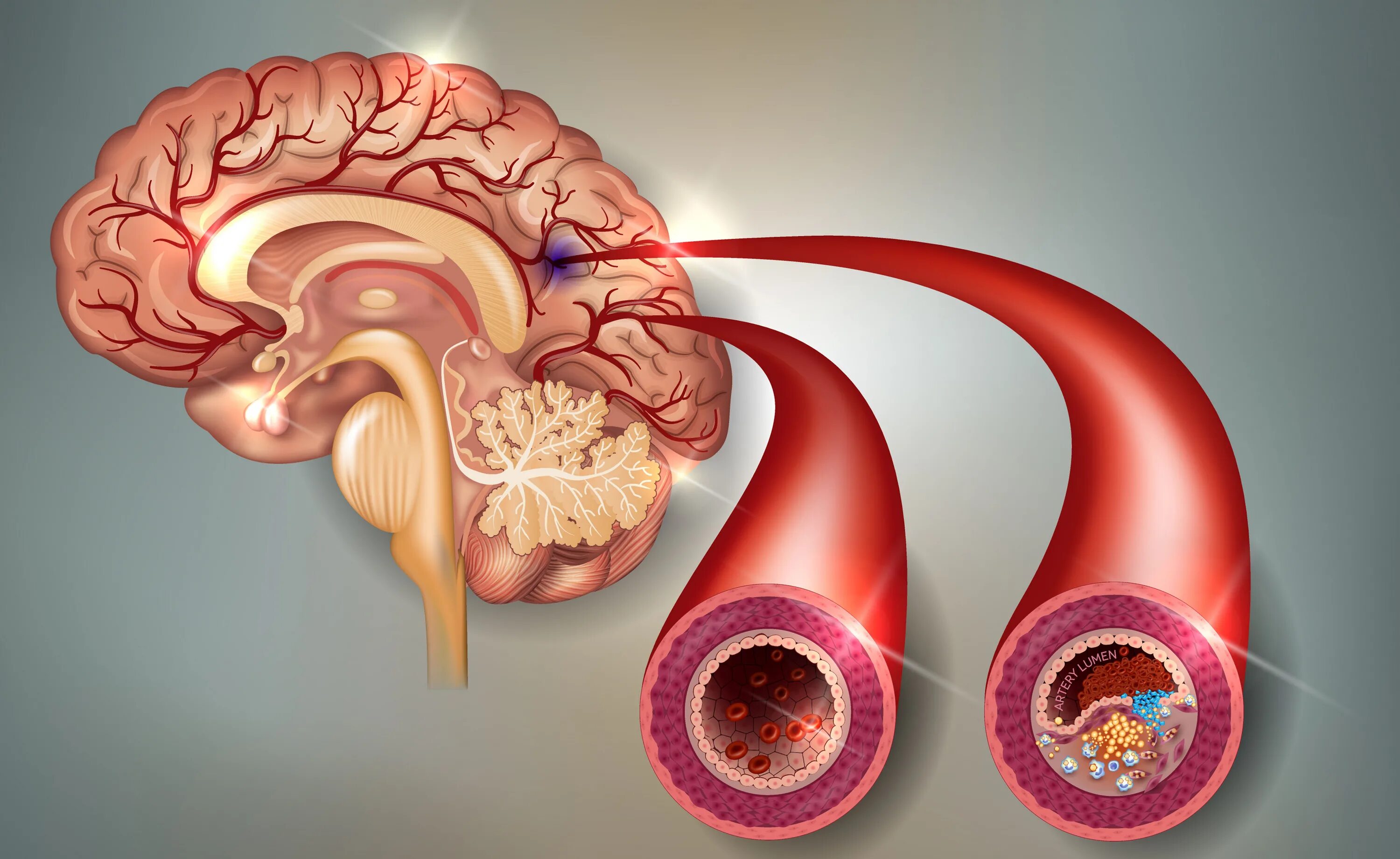 Бляшка в сосудахголовного моззга. Атеросклероз сосудов головного мозга. Атеросклероз артерий головного мозга. Тромбы после инсульта