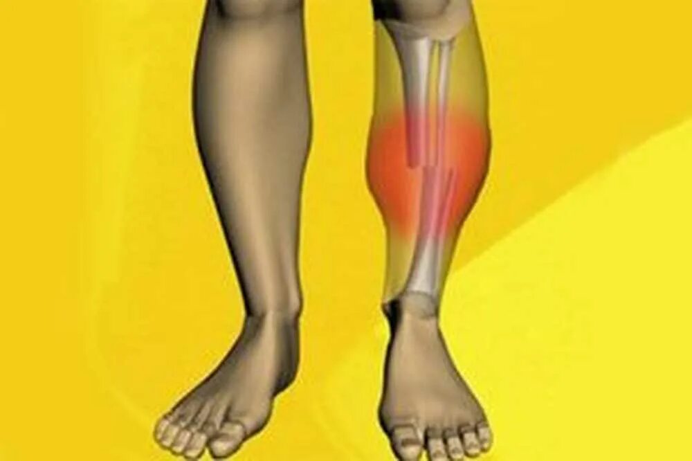 Трещина голени. Перелом малой берцовой кости ноги. Перелом берцовой кости на ноге. Перелом берцовой кости стопы. Ушиб малой берцовой кости.