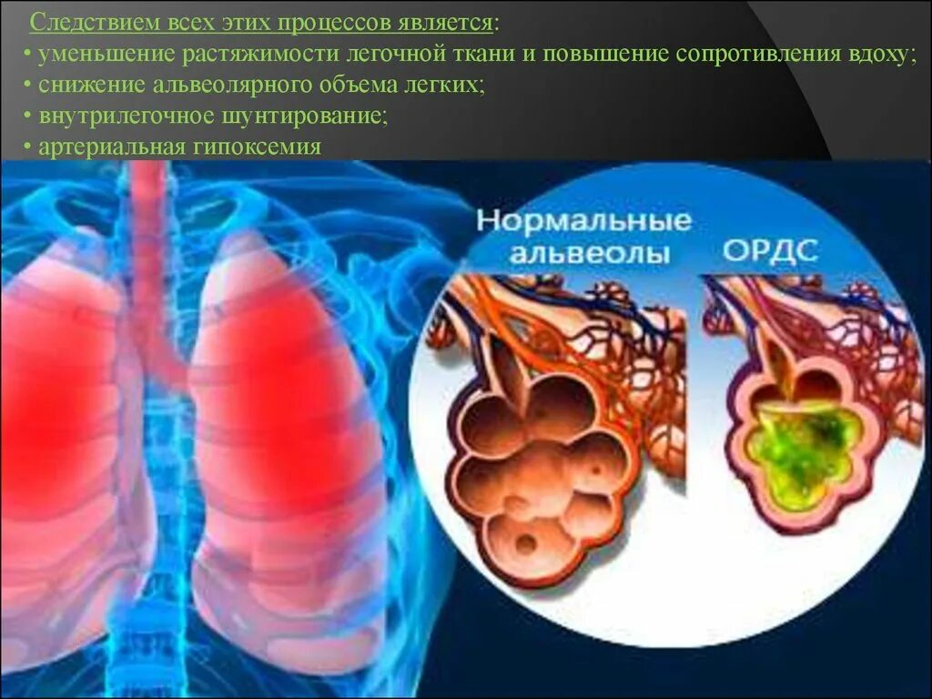 Ордс крипта. Острый респираторный дистресс-синдром. острый респираторный дистресс-синдром этиология. острый респираторный дистресс-синдром (ордс). патогенез ордс взрослых.