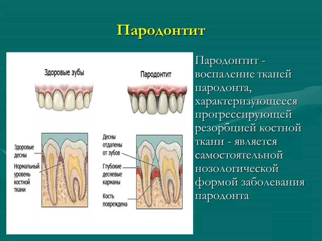 Пародонтит костной ткани. Строение пародонта и периодонта. Где находится десна