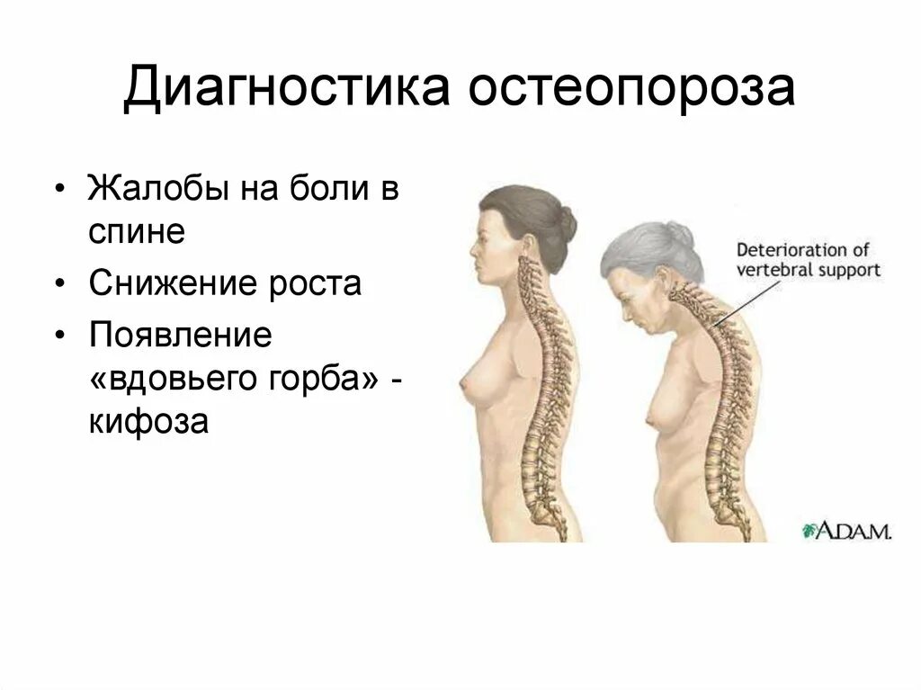 Грудной кифоз выражен