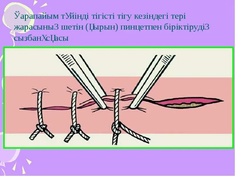 Чем можно обрабатывать швы после операции. Снятие послеоперационных швов. Хирургические швы снятия швов.