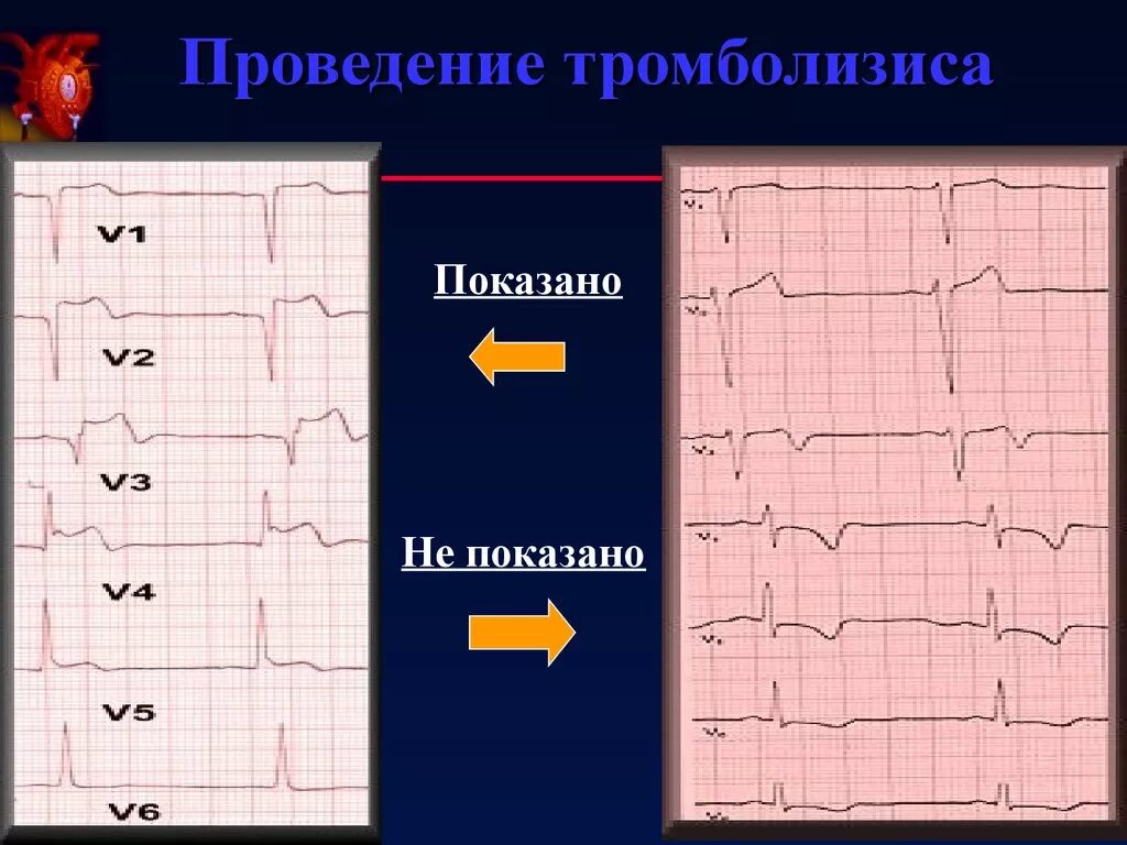 Острый коронарный синдром инфаркт. Инфаркт миокарда без подъема сегмента St ЭКГ. ЭКГ при остром коронарном синдроме. Окс на ЭКГ. ЭКГ после тромболизиса.