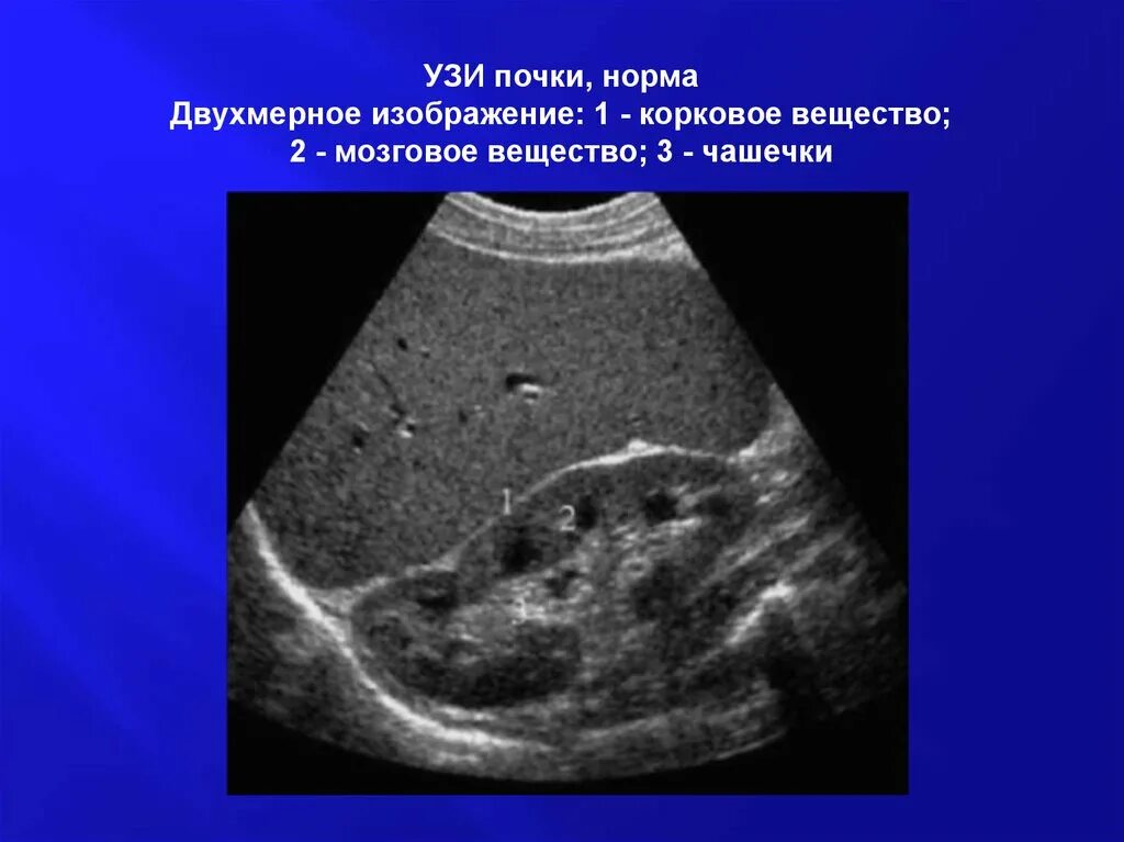 Поперечный срез почки УЗИ. Расширение чашечек почки на УЗИ. УЗИ почки на фронтальном срезе. Мозговое вещество почки УЗИ. Узи почка не видна