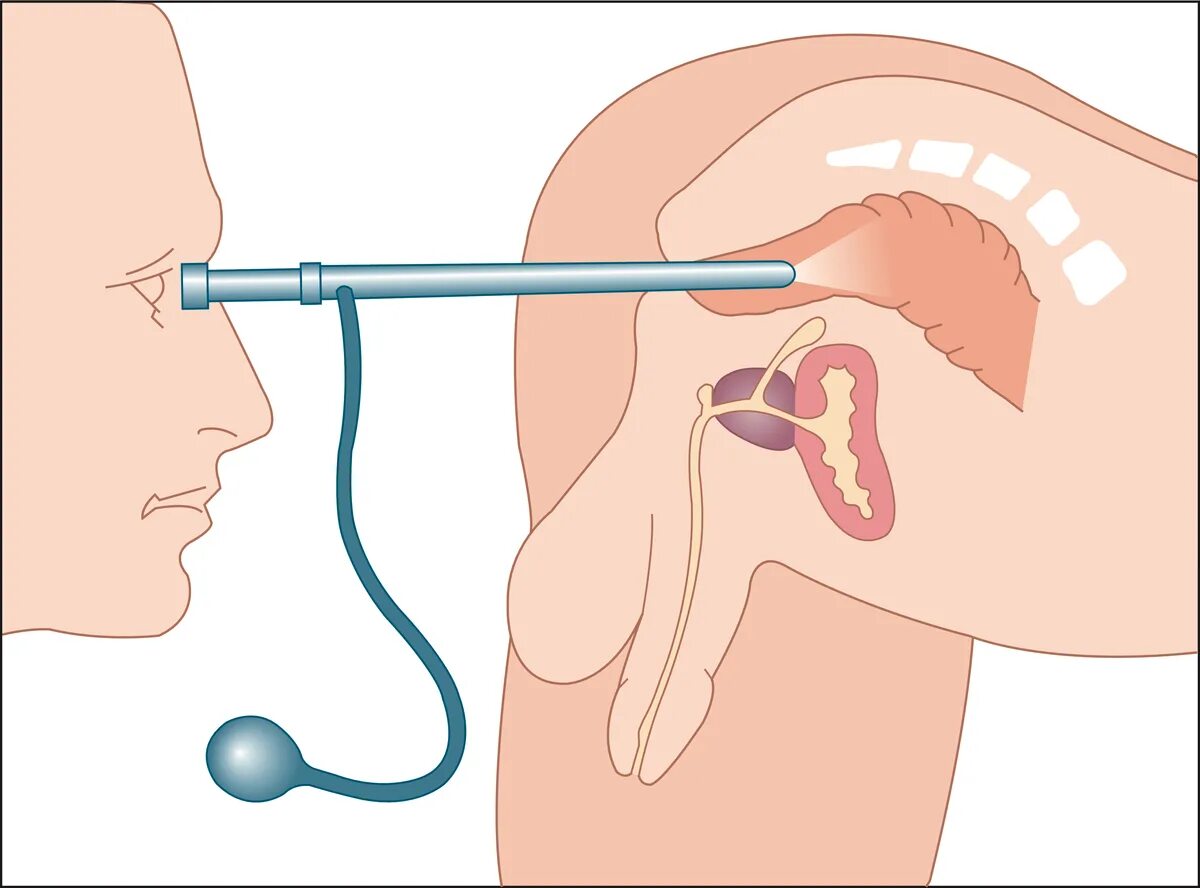 Палец проктолога. Ректороманоскопия (ректоскопия). Аноскопия и ректороманоскопия что это. Аппарат для ректороманоскопии. Исследование прямой кишки ректоскопия.