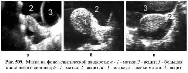 Инволютивные изменения яичников. Инволютивные изменения матки и яичников на узи. инволютивная миома матки это. инволютивные изменения придатков что это. инволютивные изменения матки и яичников что это.