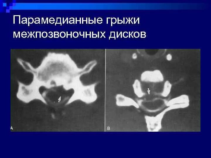 Медианно парамедианная билатеральная. Левосторонняя парамедианная экструзия диска. Парамедианная грыжа диска на кт. Задняя медианно парамедианная грыжа. Левосторонняя парамедианная фораминальная грыжа диска.