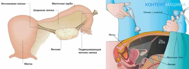 Как убирают маточные трубы. Тубэктомия маточных труб. Как убирают маточные трубы. Назовите показания для удаления маточной трубы. Как убирают маточные трубы.