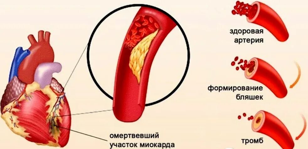Чем отличается инфаркт от обширного инфаркта. Острый инфаркт миокарда (оим). симптомы ибс инфаркт миокарда. причины развития острого инфаркта миокарда. формирование инфаркта миокарда.
