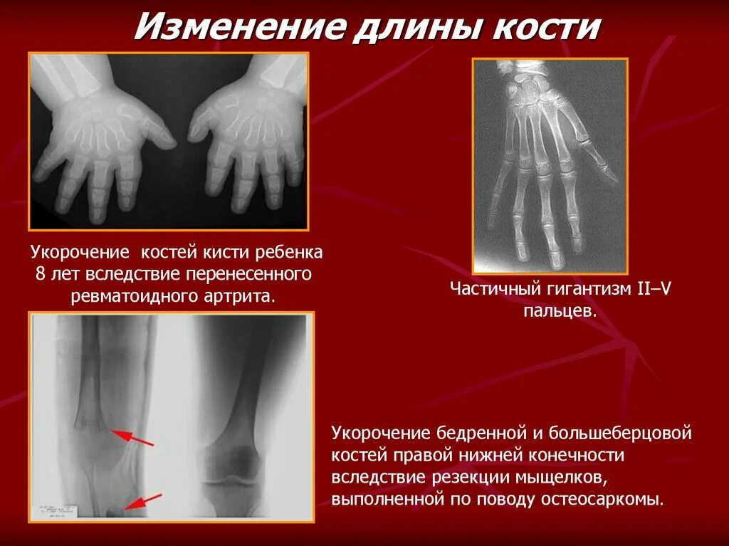 Изменение формы кости. Изменение длины костей. Заболевания костей укорочение. Укорочение длины трубчатых костей.