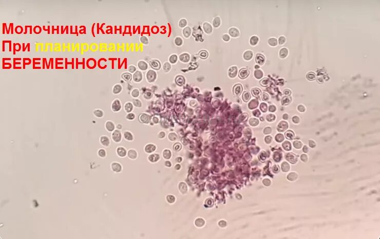 Можно ли заниматься интимной жизнью при молочнице. Грибок кандида под микроскопом. Поверхностный кандидоз. Кандидозная молочница.