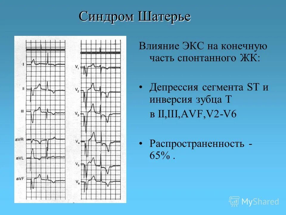 Инверсия зубца т. Зубец q ii iii avf. инверсия зубца т ii , iii , avf. синдром шатерье. синдром шатерье при экс.