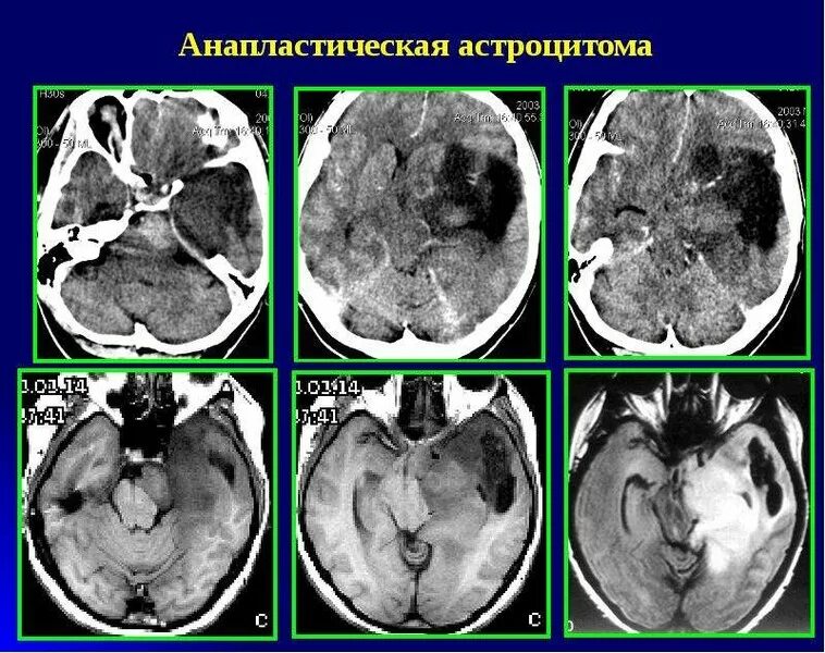 Астроцитома головного мозга прогноз. Анапластическая астроцитома g3. Анапластическая астроцитома кт. Анапластическая астроцитома мрт. Анапластическая астроцитома ПЭТ-кт.