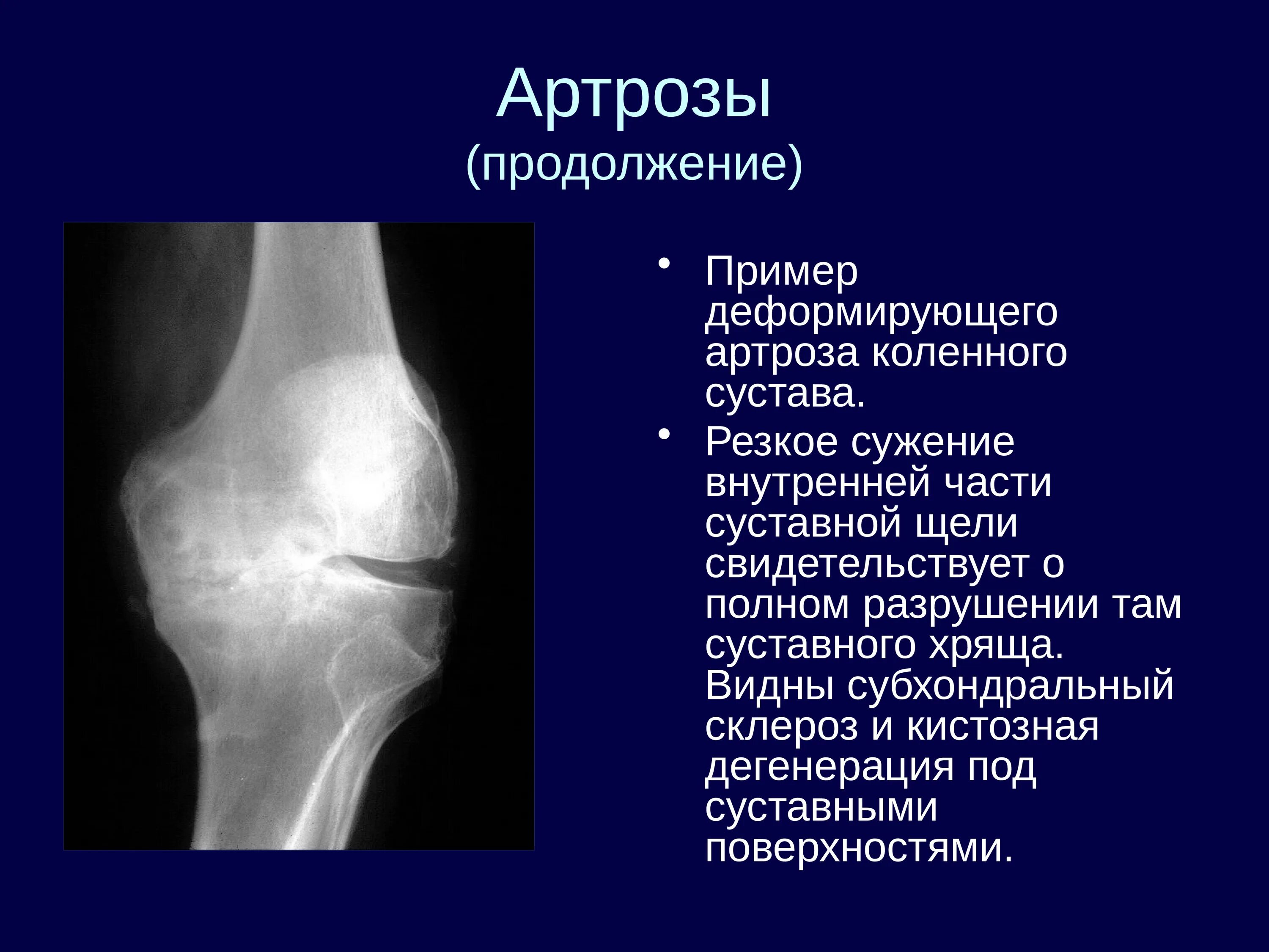 Деформирующий гонартроз рентгенодиагностика. Субхондральный остеоартроз. Деформирующий артроз локтевого рентген. Коленного сустава опухоль бедренной кости рентген.