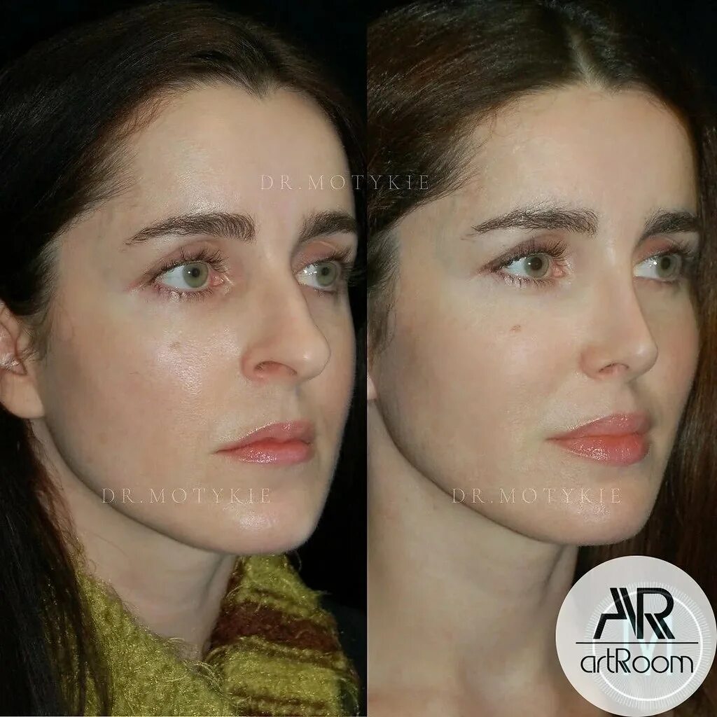 функциональная ринопластика белоусов. ринопластика рубцы келоидные. массаж. пластическая операция на нос. ринопластика до и после.