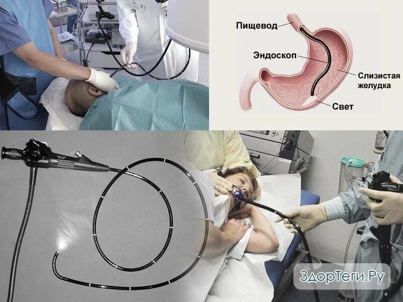 Диаметр трубки 9,3мм ФГДС. Тонкий эндоскоп ФГДС