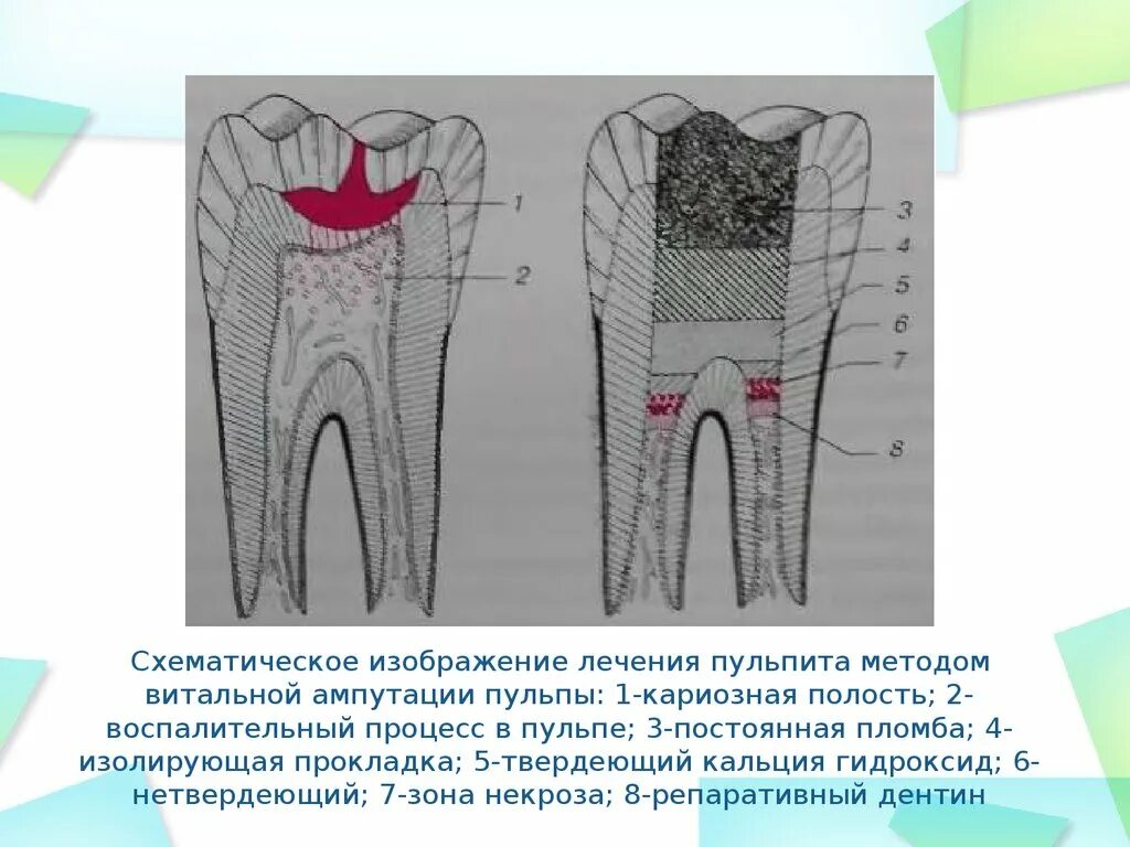 Витальная ампутация пульпы методика. Пульпит. 1 Метод витальной ампутации..