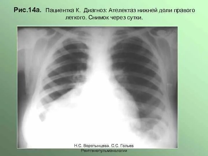 Затемнение верхней доли легкого. Ателектаз нижней доли рентген. Ателектаз средней правого легкого. Ателектаз легких рентген. Ателектаз верхней доли рентген.