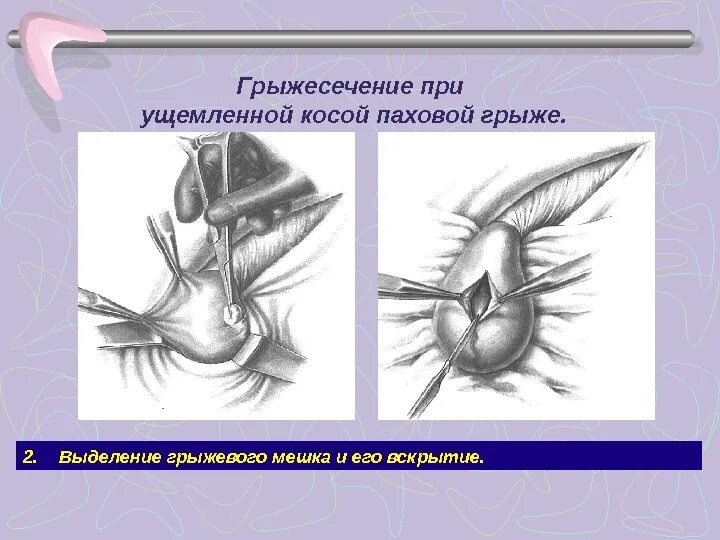 Этапы операции при ущемленных грыжах. Ущемленная грыжа этапы операции. Грыжесечение при ущемленной паховой грыже. Герниотомия ущемленной грыжи.