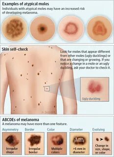 atypical moles.