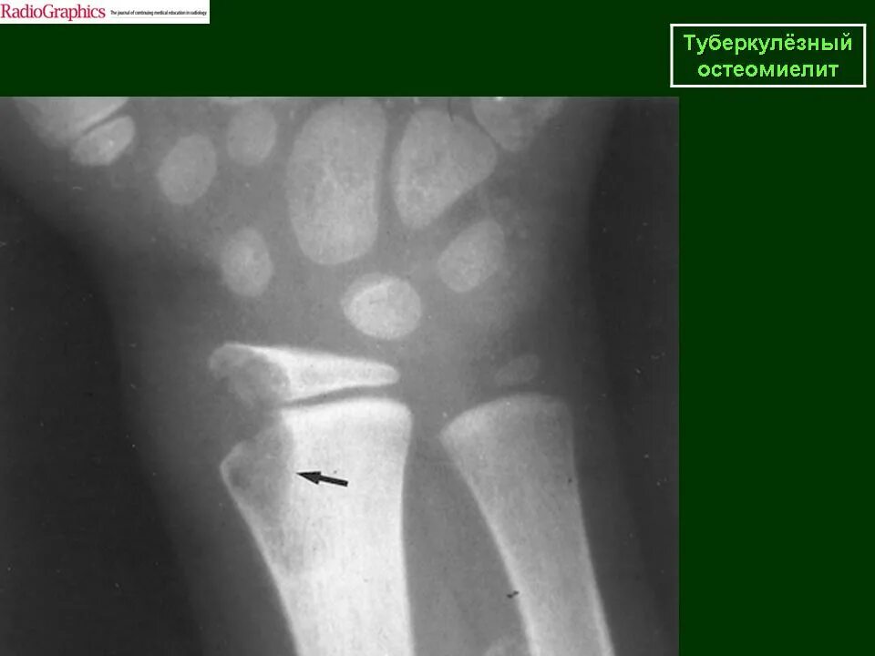 Костно-суставной туберкулез рентген. Костно-суставной туберкулез снимки. Туберкулез кости рентген. Первичный остит туберкулез.